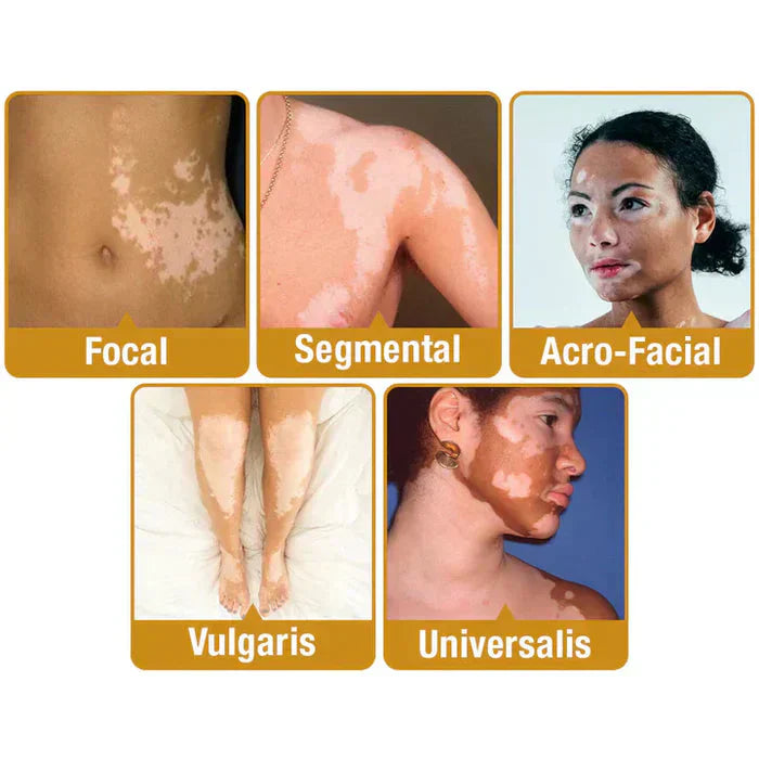 Bee Venom Vitigo Correcting Cream - (Pack of 2)